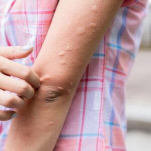 What Bugs Can Cause Allergic Reactions