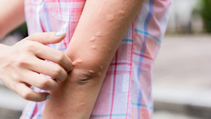 What Bugs Can Cause Allergic Reactions