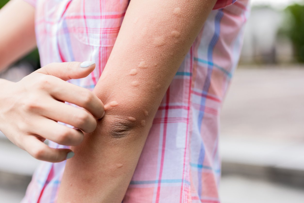 What Bugs Can Cause Allergic Reactions